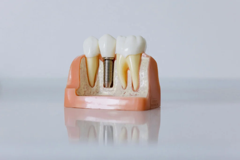 que son los implantes dentales